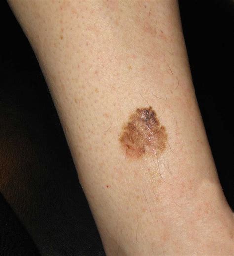 melanoma skin cancer pictures on leg